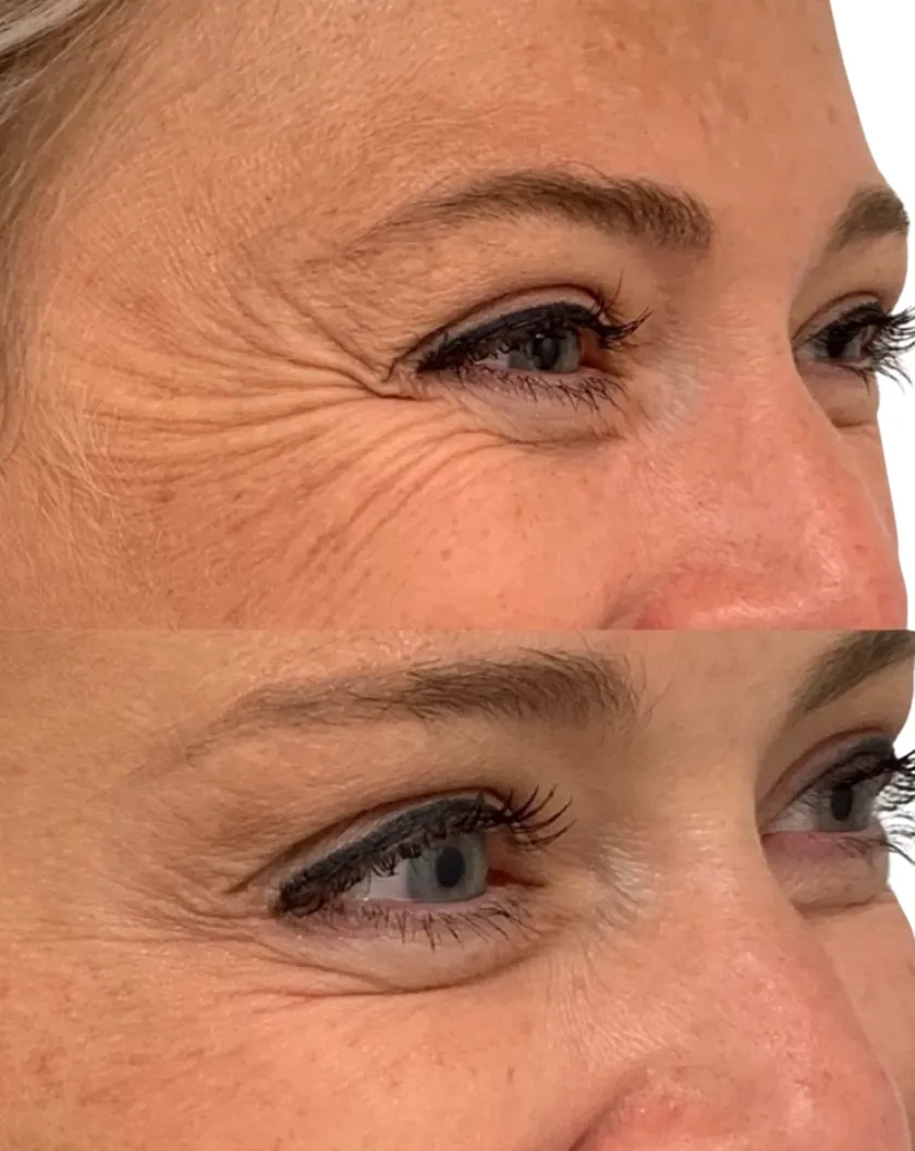 Lines at the corner of the eye before treatment and softer after treatment.