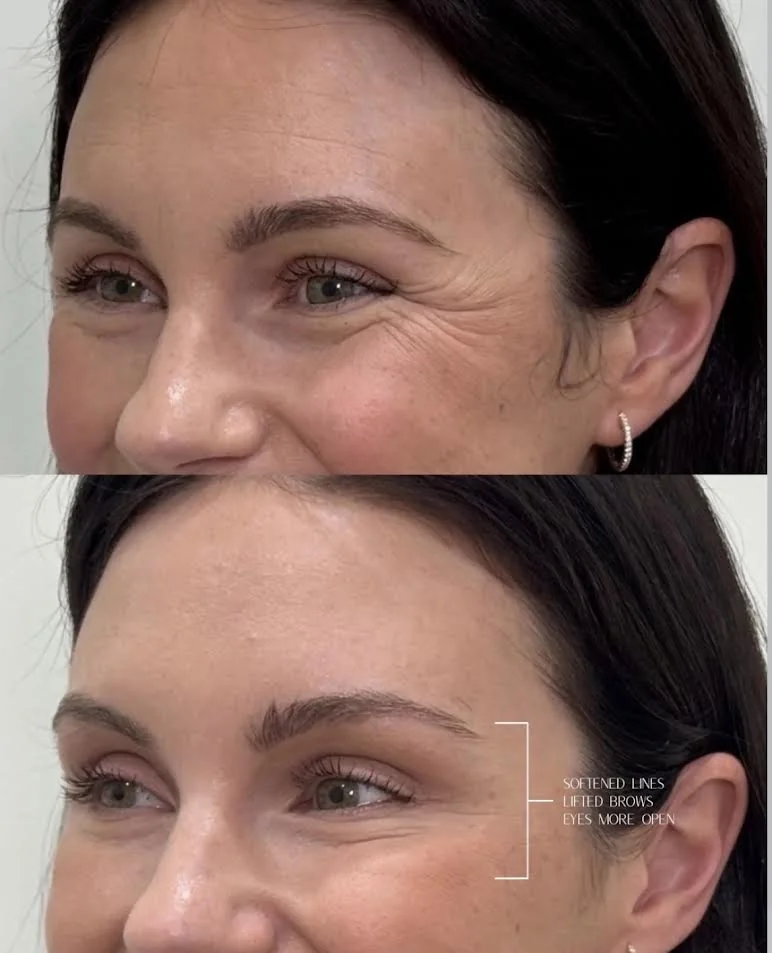 Lines around the eye before treatment and softer with a more open brow after treatment.