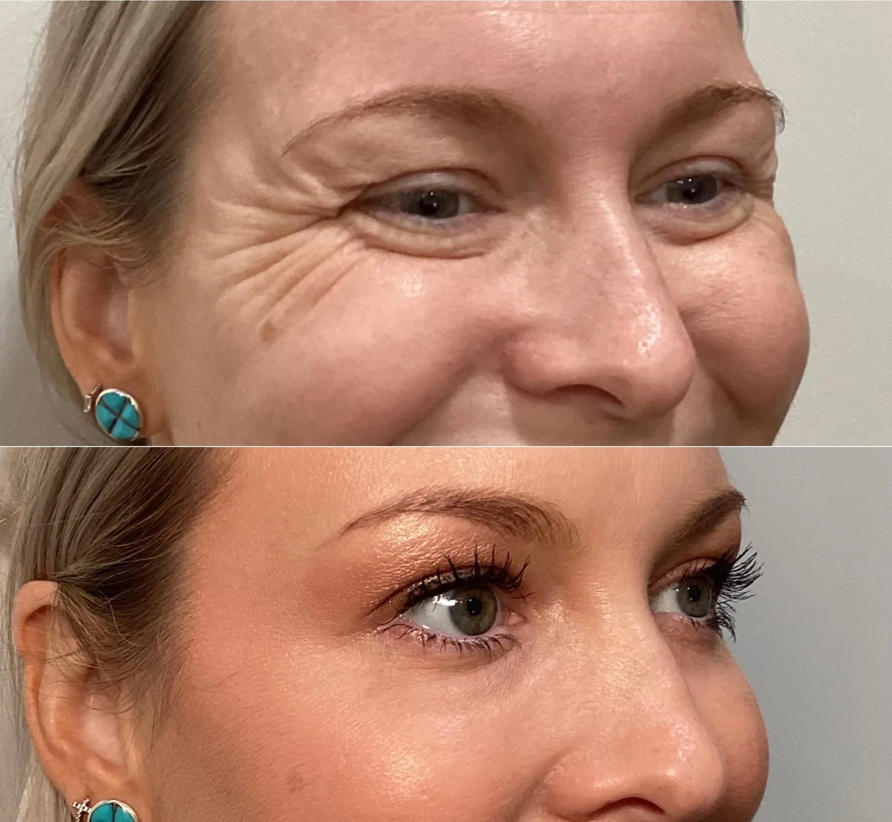 Lines at the eye area before treatment and softer after treatment.