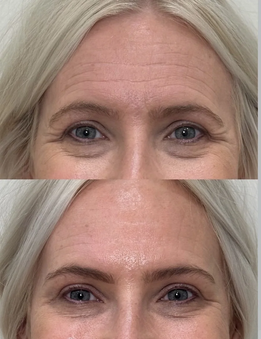 Deep forehead lines before treatment and smoother after treatment.