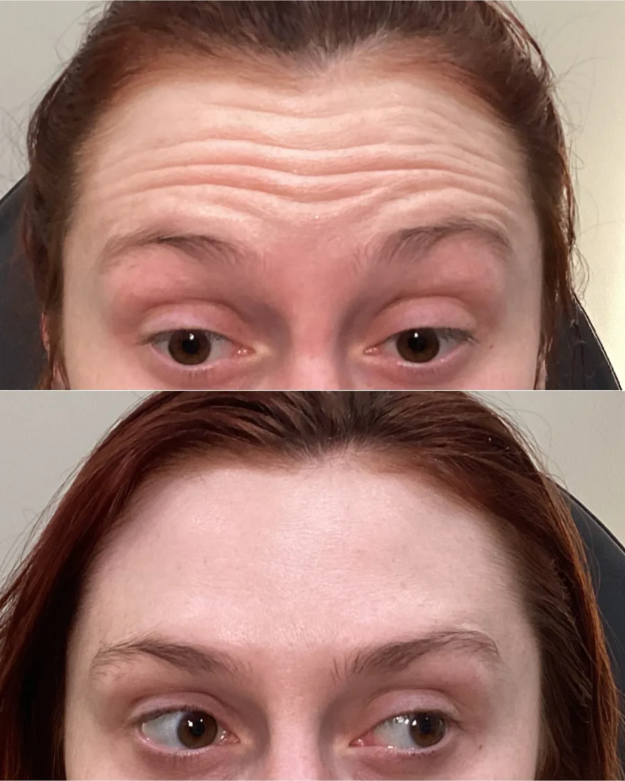 Lines across the forehead before treatment and smoother after treatment.