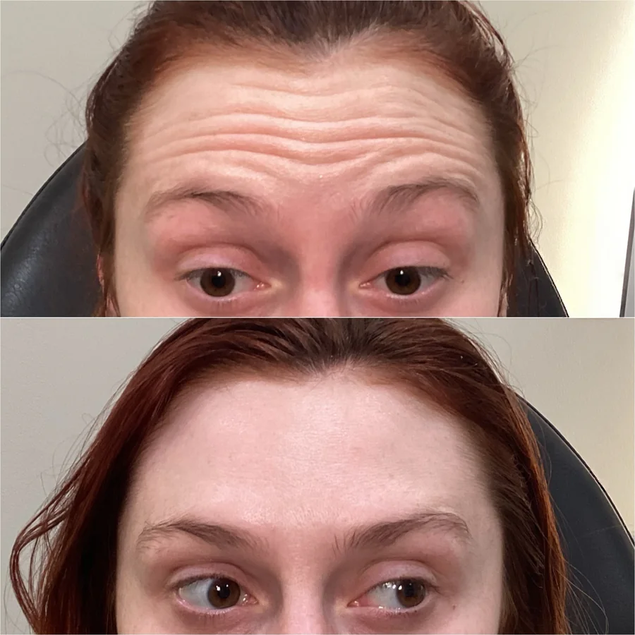 Deep forehead lines before treatment and smooth after treatment.